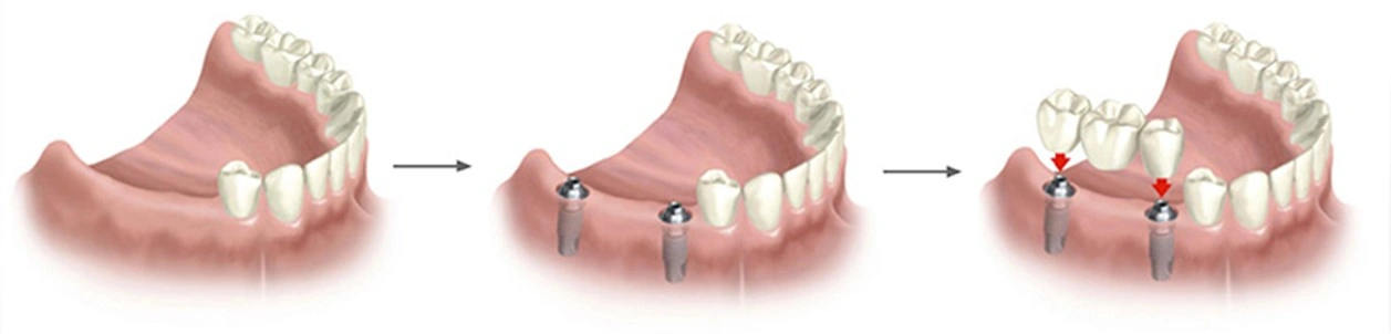 implantes dentales tratamiento